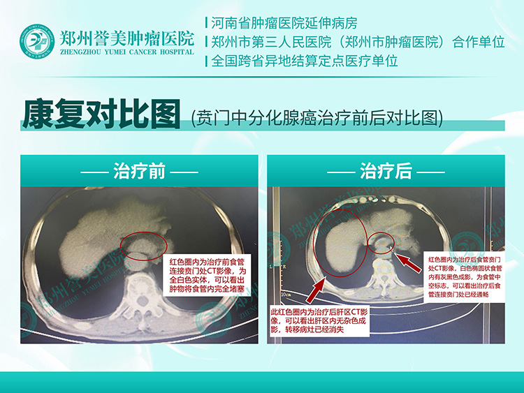 1776151544881842.jpg 安徽贲门癌 刘其新.jpg