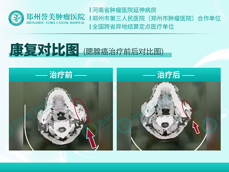 1776151558883460.jpg 河北腮腺癌-关燕.jpg